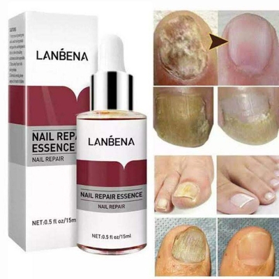 Picture of Lanbena Nail Fungal Treatment Remove Paronychia Onychomycosis Toe Nail Repairing,Treatment Toe Nail Repair Essence Nail Solution-15Ml