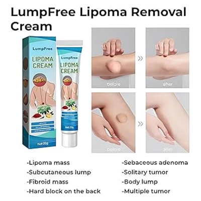 Picture of South moon Lipoma Removal Spray. it is a topical spray designed to help with the removal of benign lipomas which are soft,fatty, lumps that grow under the skin 50ml