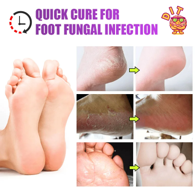 Picture of KangHE Foot Care Cream – 20g Anti-Fungal Treatment for Athlete’s Foot, Itching, Odor & Peeling – Fast-Acting Medicated Cream
