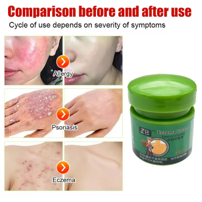 Picture of Fezema Graffi Eczema Cream – 20g Psoriasis & Dermatitis Treatment – Chinese Herbal Anti-Itch Ointment for Cracked, Scaly Skin Repair