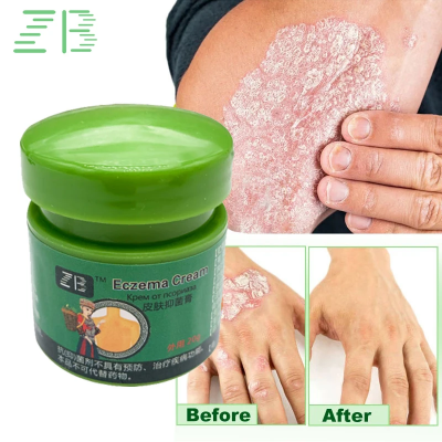 Picture of Fezema Graffi Eczema Cream – 20g Psoriasis & Dermatitis Treatment – Chinese Herbal Anti-Itch Ointment for Cracked, Scaly Skin Repair
