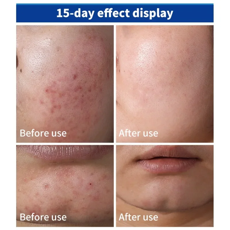 Picture of EELHOE Soothing B5 Repair Cream – Cicaplast Moisture Fall Cream for Redness, Itching & Sunburn Relief | Vitamin B5 + Centella Asiatica