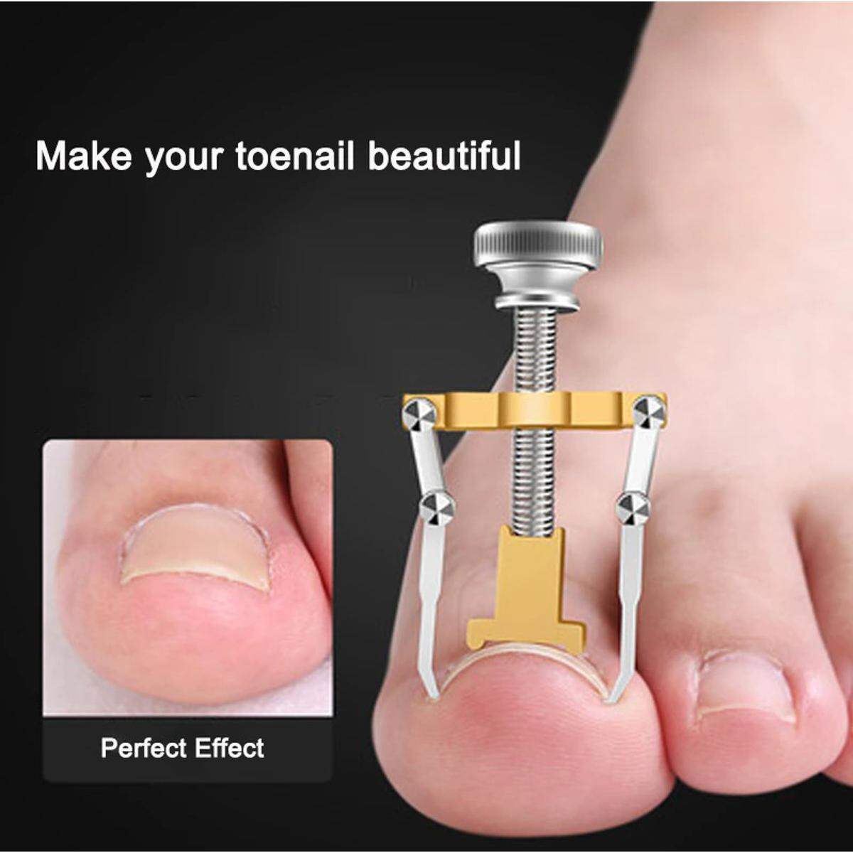 Picture of Ingrown Toenail Toe Fixer Recover Correction Device Pedicure Foot Nail Care Tool Straightening Clip Brace Corrector Easy To Use - Pedicure Set - Gold - Int: One size
