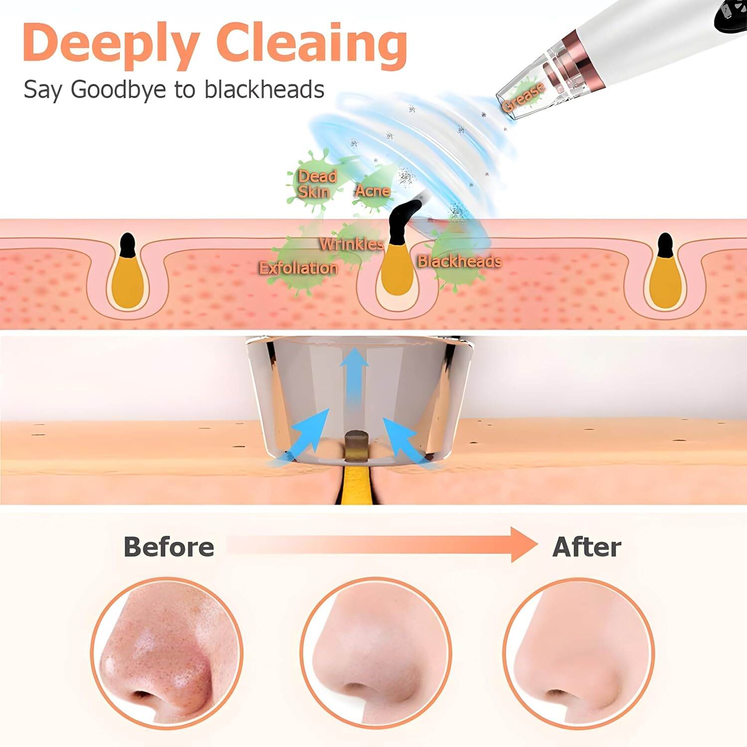 Picture of 6 In 1 Multi-Function Blackhead Remover Tool, USB Rechargeable Derma suction Machine, Pimple Removal Tool for Men and Women - Int: One size