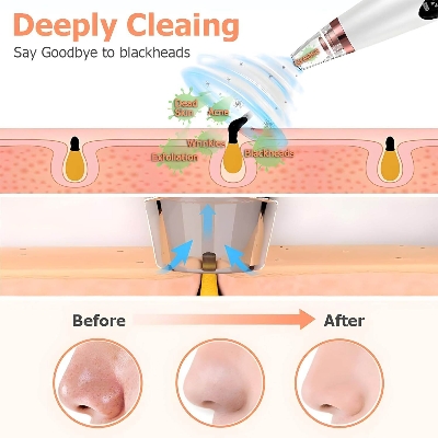 Picture of 6 In 1 Multi-Function Blackhead Remover Tool, USB Rechargeable Derma suction Machine, Pimple Removal Tool for Men and Women - Int: One size