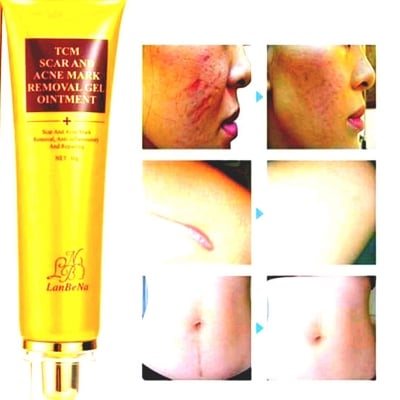 Picture of acne spots stretch mark 30 ml