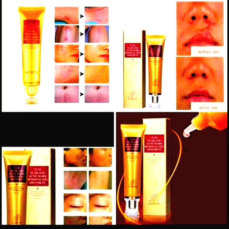 Picture of acne spots stretch mark 30 ml