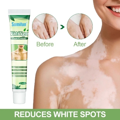 Picture of 20g Herbal Vitiligo Treatment Cream – Natural Spot Removal Ointment for vitiligo Spots Pigmentation & Brown Spots –Face & Body, Adults & Children
