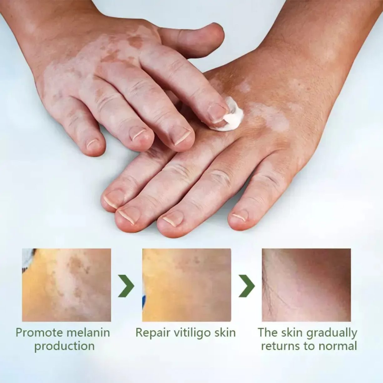 Picture of 20g Herbal Vitiligo Treatment Cream – Natural Spot Removal Ointment for vitiligo Spots Pigmentation & Brown Spots –Face & Body, Adults & Children