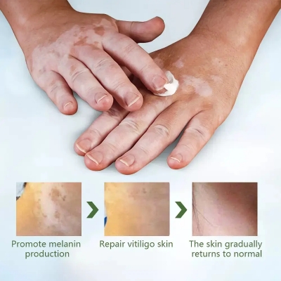 Picture of 20g Herbal Vitiligo Treatment Cream – Natural Spot Removal Ointment for vitiligo Spots Pigmentation & Brown Spots –Face & Body, Adults & Children