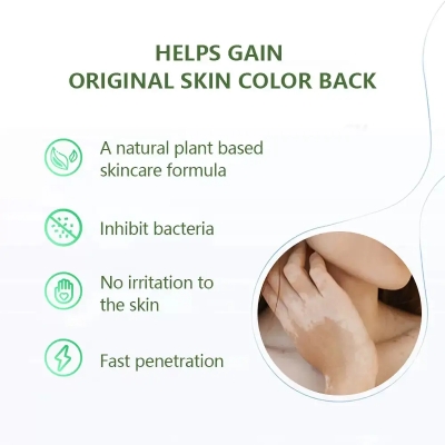 Picture of 20g Herbal Vitiligo Treatment Cream – Natural Spot Removal Ointment for vitiligo Spots Pigmentation & Brown Spots –Face & Body, Adults & Children