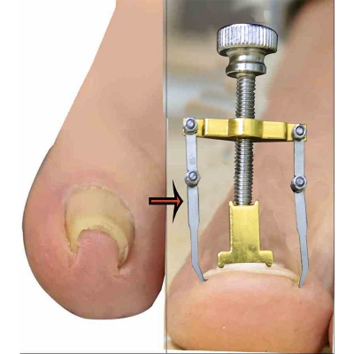Picture of নখের কোনা সোজা করার অত্যাধুনিক যন্ত্র (Nail Repair)