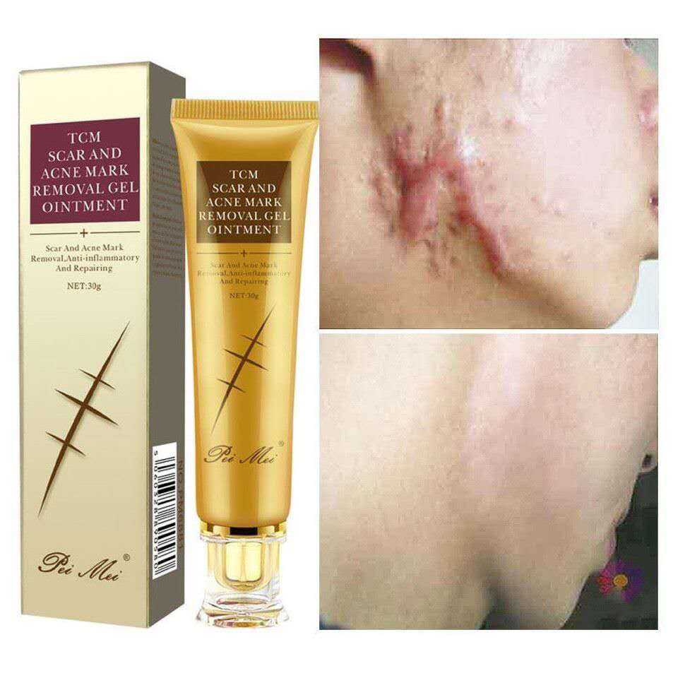 Picture of TCM Scar Acne Mark Removal Gel Ointment, 30g