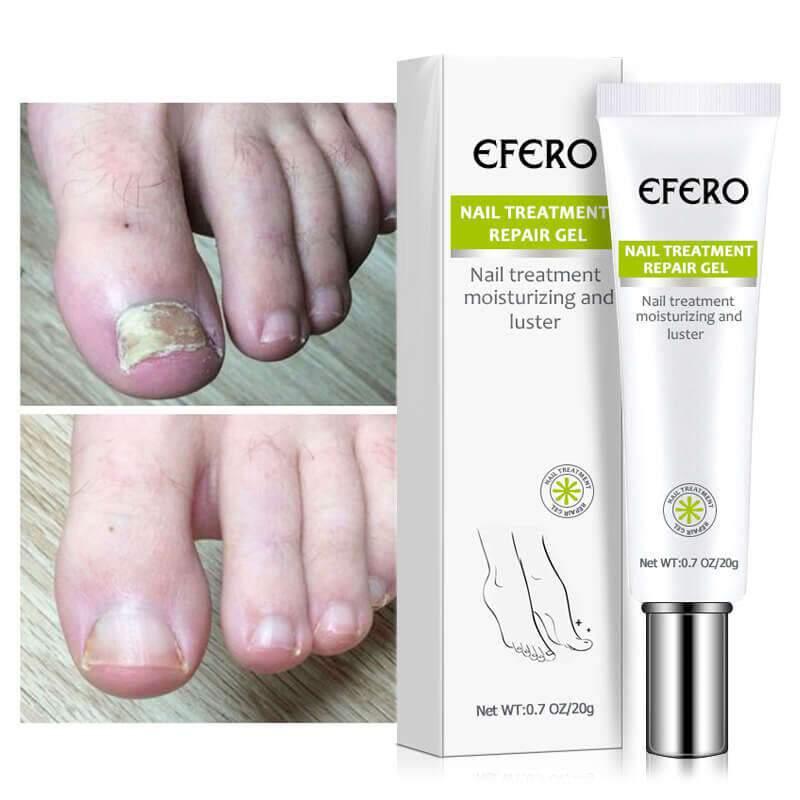 Picture of Nail Repair Gel Fungus Treatment Solution Anti fungal Removal Infection Cuticle Toe Nail Foot Protector Cream-White