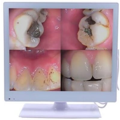 Picture of Dental Intra Oral-Camera