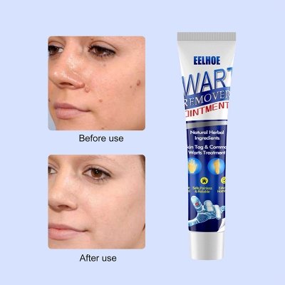 Picture of Warts & Skin Tag Remover Ointment: Treatment Cream - Blue