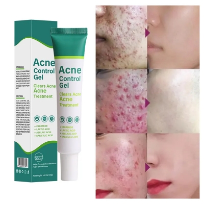 Picture of Acne Control Gel Clears Acne Acne Treatment