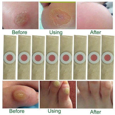 Picture of 6 pcs Medical Plasters Foot Corn Removal Warts Thorn Patch Curative Patches Calluses Callosity Detox Foot Pads Toe Patches ()