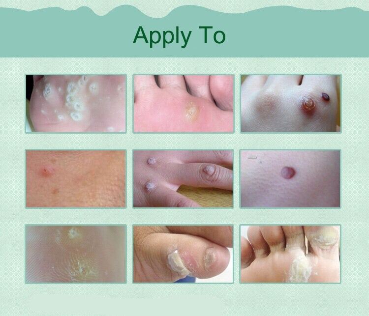 Picture of 6 pcs Medical Plasters Foot Corn Removal Warts Thorn Patch Curative Patches Calluses Callosity Detox Foot Pads Toe Patches ()