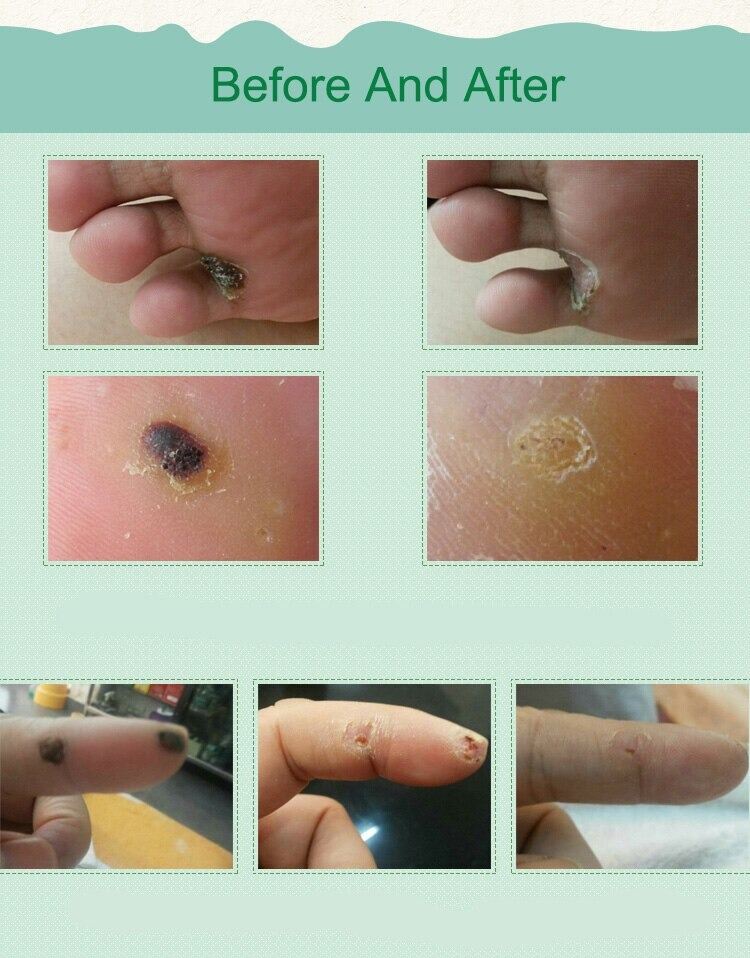 Picture of 6 pcs Medical Plasters Foot Corn Removal Warts Thorn Patch Curative Patches Calluses Callosity Detox Foot Pads Toe Patches ()