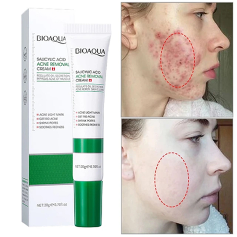 Picture of BIOAQUA Acne Removal Cream Anti Acne Treatment Repair Marks Moisturizing Blackhead Remover Facial Cream Skin Care-20gm 