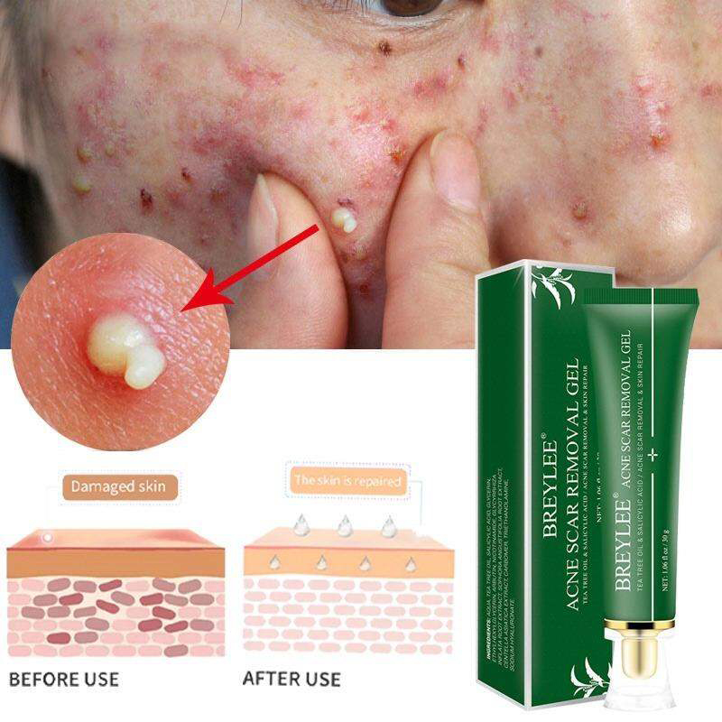 Picture of BREYLEE Acne Scar Removal Gel Fade Acne Marks Spots Remove Skin Pigmentation Soothing Prevent Acne Treatment Serum Essence -30gm 
