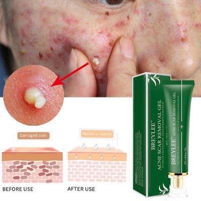 Picture of BREYLEE Acne Scar Removal Gel Fade Acne Marks Spots Remove Skin Pigmentation Soothing Prevent Acne Treatment Serum Essence -30gm 
