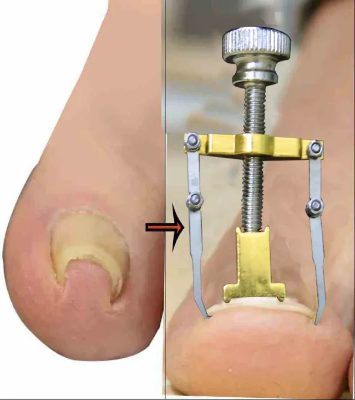 Picture of Nail Care machine for nail repair Pedicure Correction Tool Foot Correcting Device Ingrown Toenail Fixer Toe nail Recover-The Asia Express-Gold