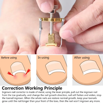 Picture of Nail Care machine for nail repair Pedicure Correction Tool Foot Correcting Device Ingrown Toenail Fixer Toe nail Recover-The Asia Express-Gold