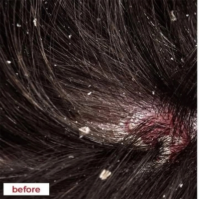 Picture of Nizoral 2% Ketoconazole Hair Care Anti-Dandruff Shampoo 50ml