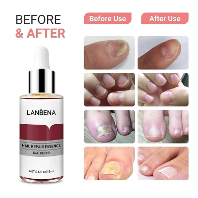 Picture of LANBENA Nail Repair Essence 15ml