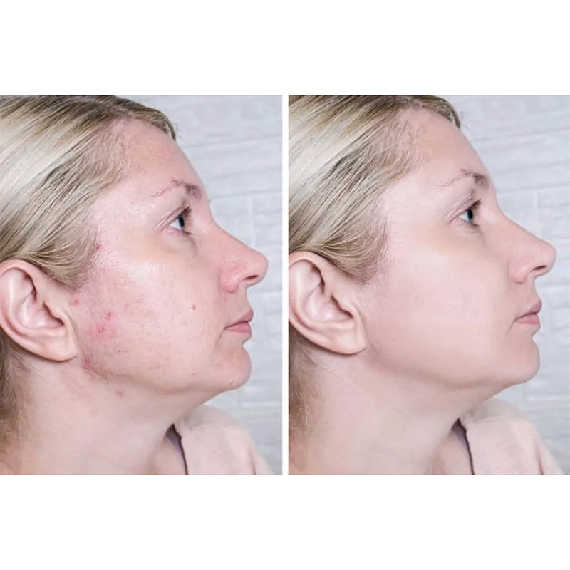 Picture of Acne Cream Scar Treatment Fast Acting - 24-Hour Spot Reduction, Anti Acne Formula, Sensitive Skin Safe, Includes Rapid Acne Scar Removal, Moisturizer, Deep Pore Cleansing - 15g