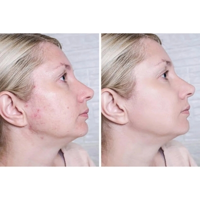 Picture of Acne Cream Scar Treatment Fast Acting - 24-Hour Spot Reduction, Anti Acne Formula, Sensitive Skin Safe, Includes Rapid Acne Scar Removal, Moisturizer, Deep Pore Cleansing - 15g
