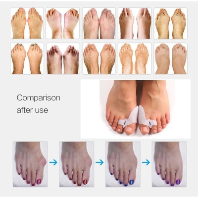 Picture of Big Toe Straightener Thumb Valgus Protector Silicone Gel Foot Fingers Toe Separator Bunion Adjuster Feet Pads Relief Foot Pain