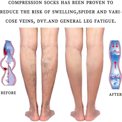 Picture of 20-30 mmHg Medical Compression Socks for Women and Men Knee High Stockings Varicose Vein Swollen legs-Beige